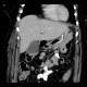 Sleeve gastrectomy: CT - Computed tomography